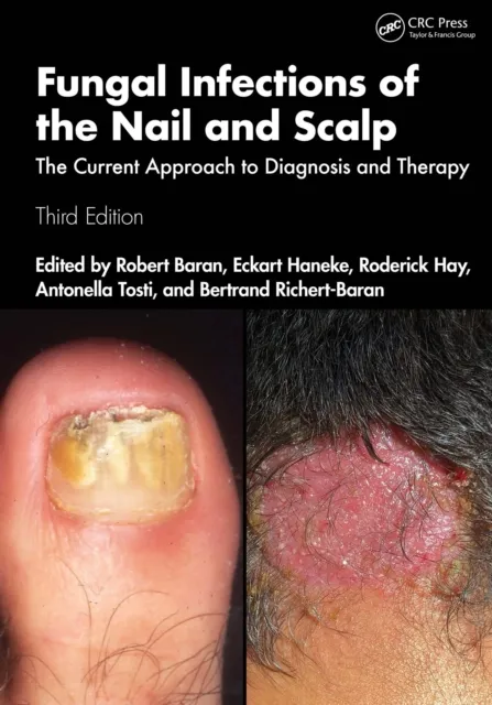 Fungal Infections of the Nail and Scalp