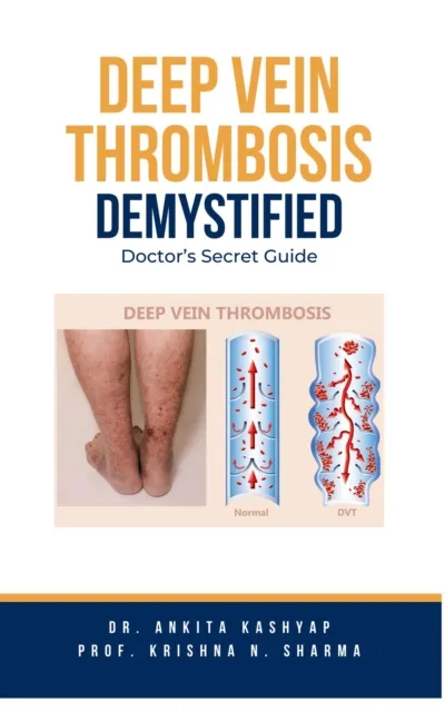 Deep Vein Thrombosis Demystified: Doctor's Secret Guide
