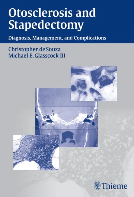 Otosclerosis and Stapedectomy