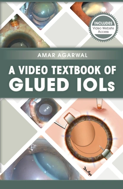 Video Textbook of Glued IOLs
