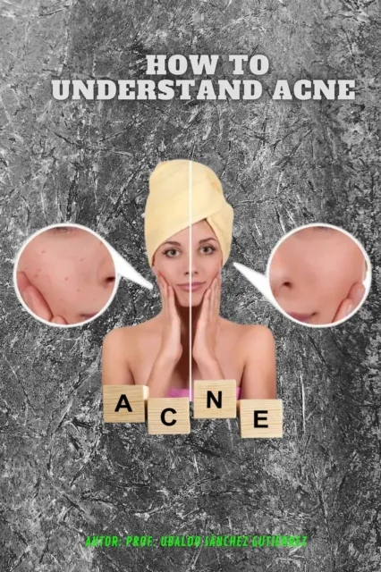 Understanding acne