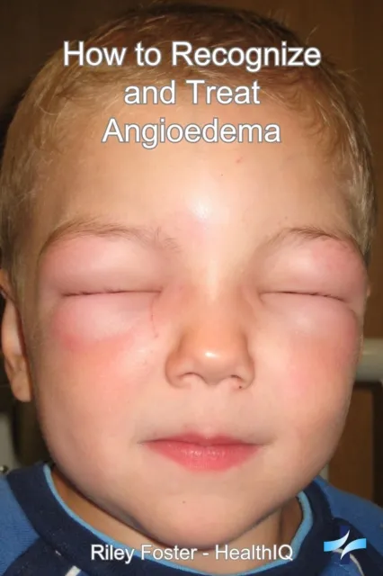 How to Recognize and Treat Angioedema
