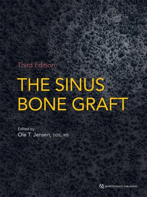 Sinus Bone Graft